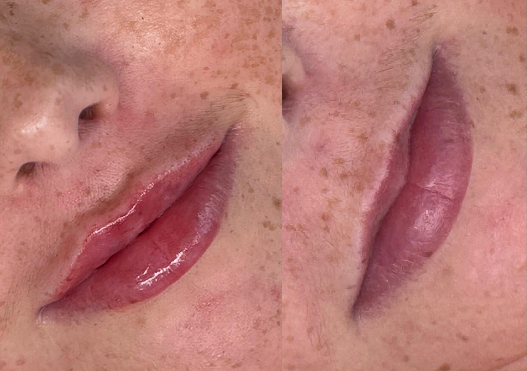 Russain lip augmentation 0.5 