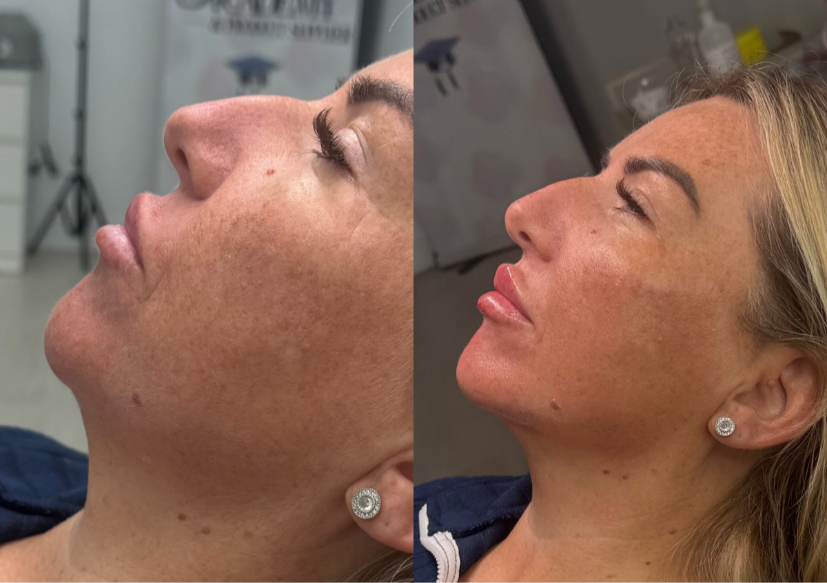 Chin filler augmentation 