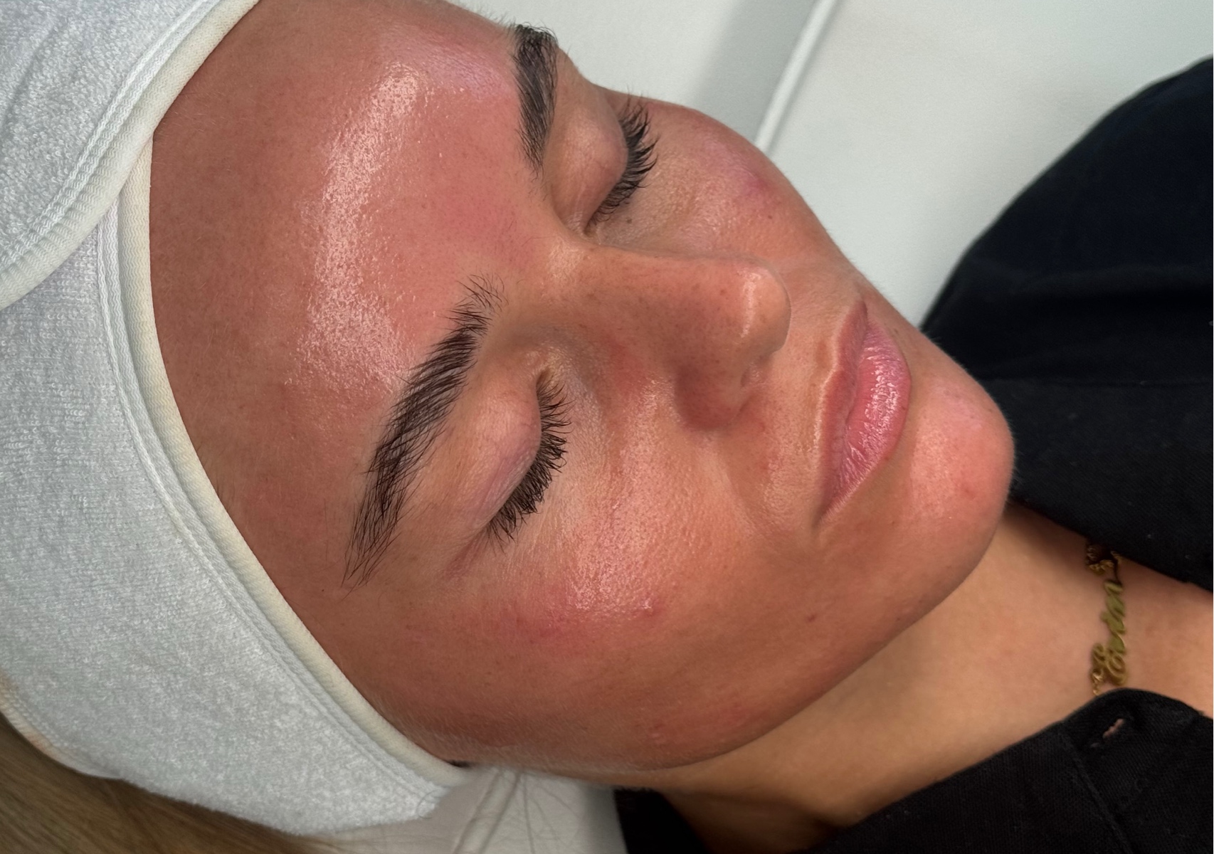 Microneedling facial PDRN 