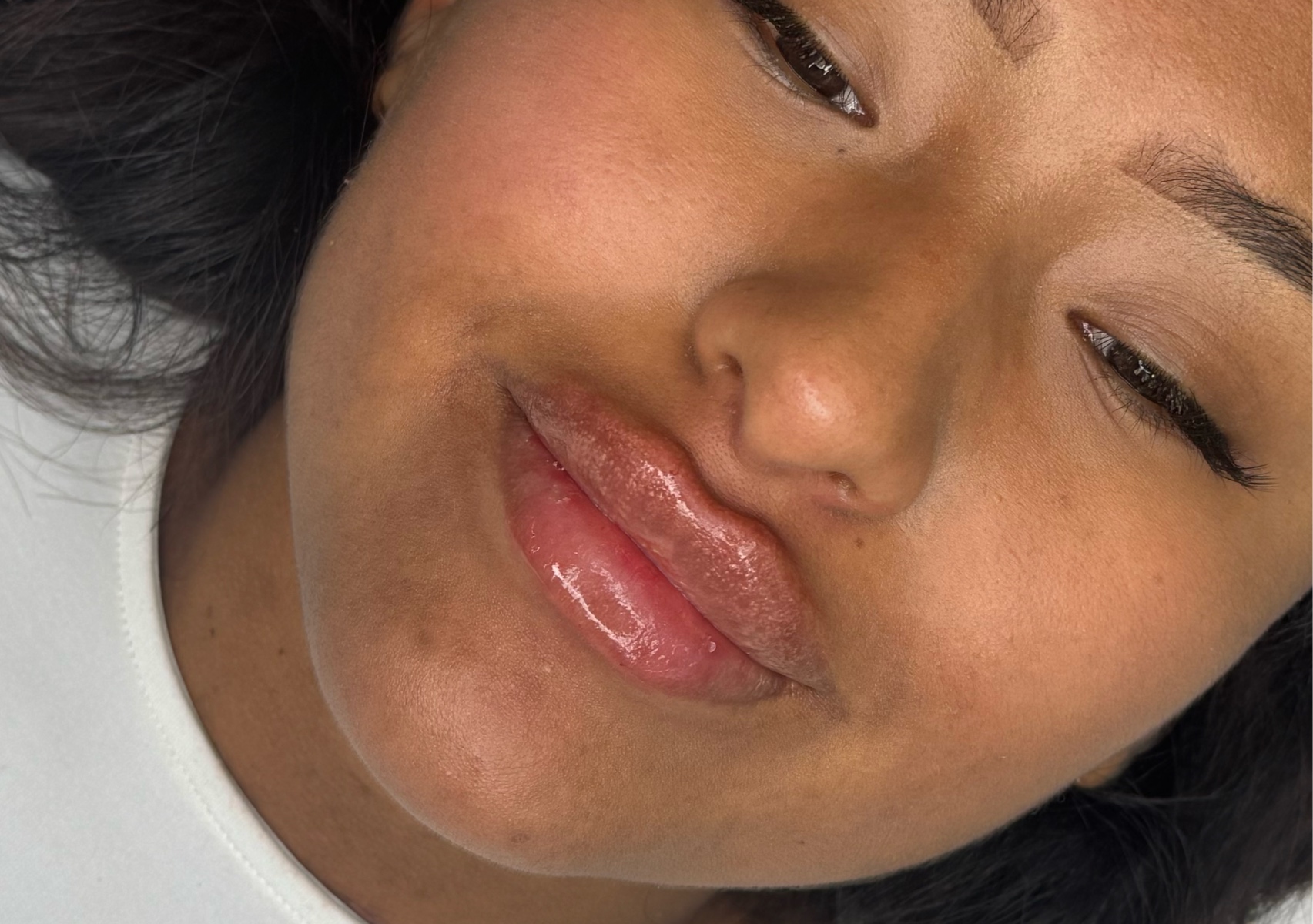 Russian lip augmentation 1ml