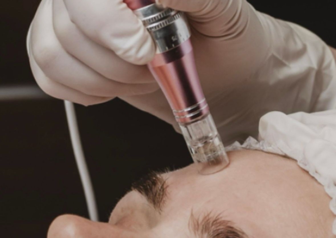 Microneedling