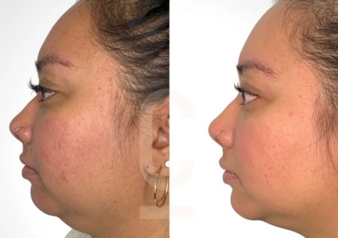 Chin reduction plus RF tightening