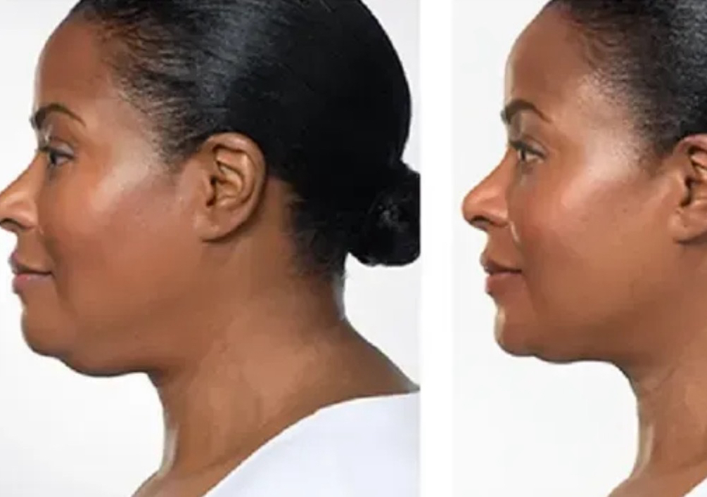 Double Chin Reduction (cavi-lipo)  60 mins.