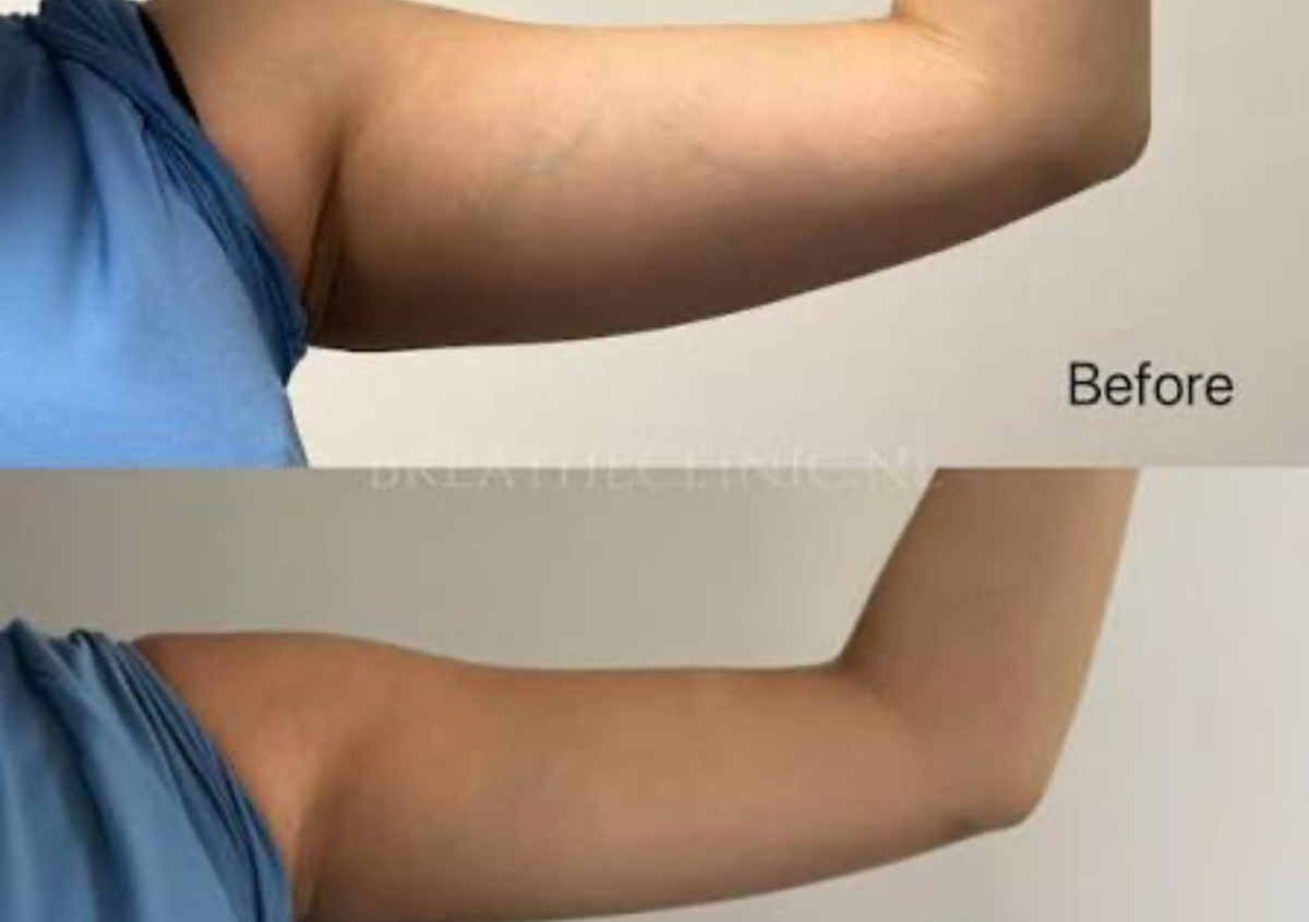 Arm Reduction (cavi-lipo)    60 mins.