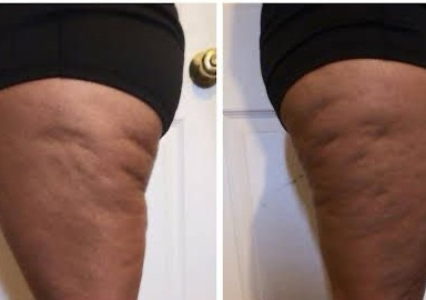 Cellulite Reduction (cavi-lipo).   60 mins.