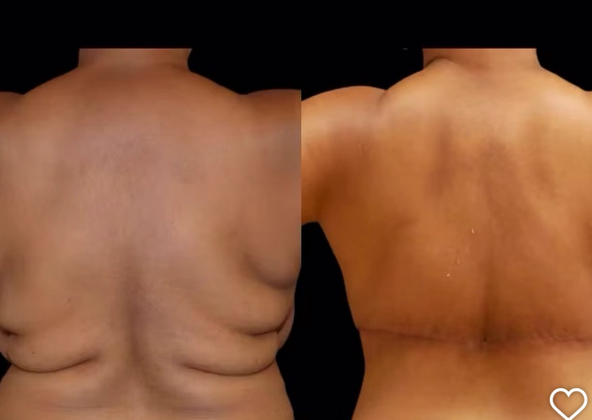 Backfat Reduction (cavi-lipo).  60 mins.