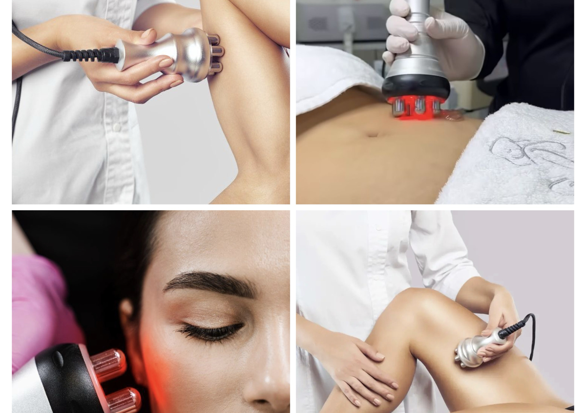 RF Skin Tightening (face arms stomach legs