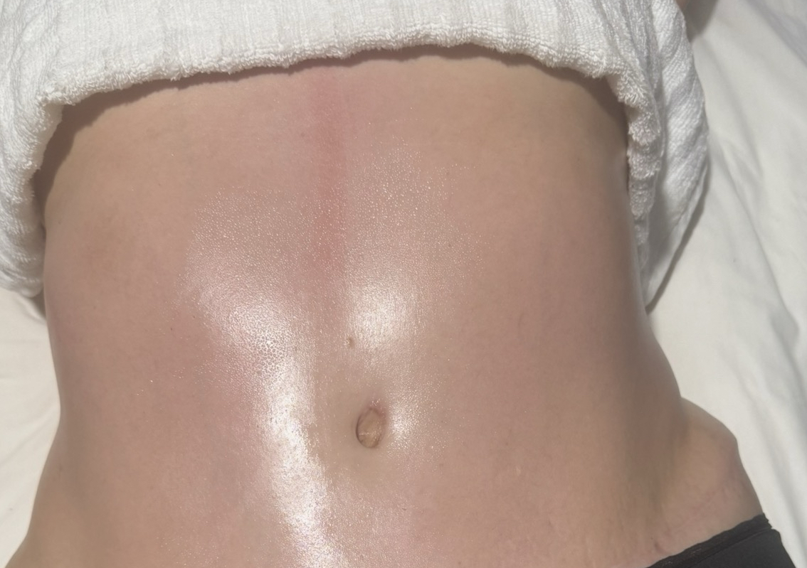Masaje linfático post operatorio 