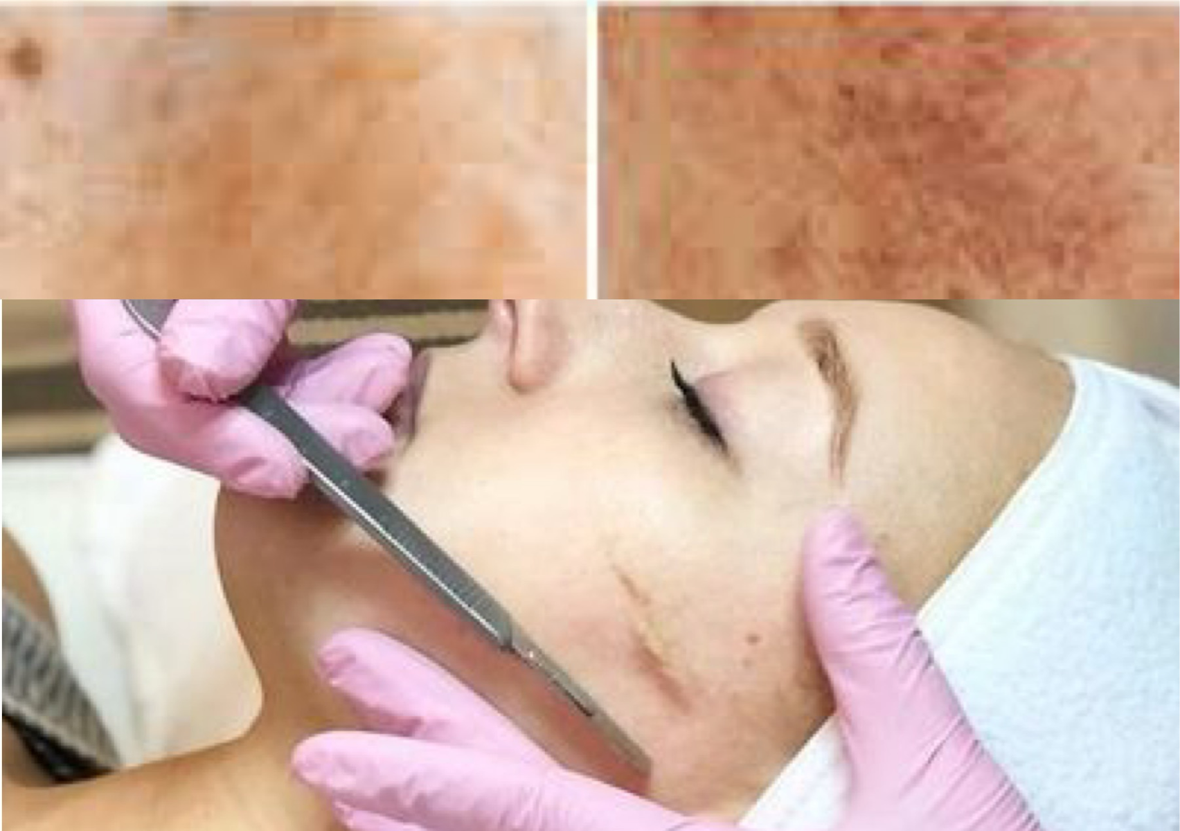 Hydrodermabrasion/microdermabrasion/ Facial Anti-Aging & Dark spots treatment included Dermaplane 