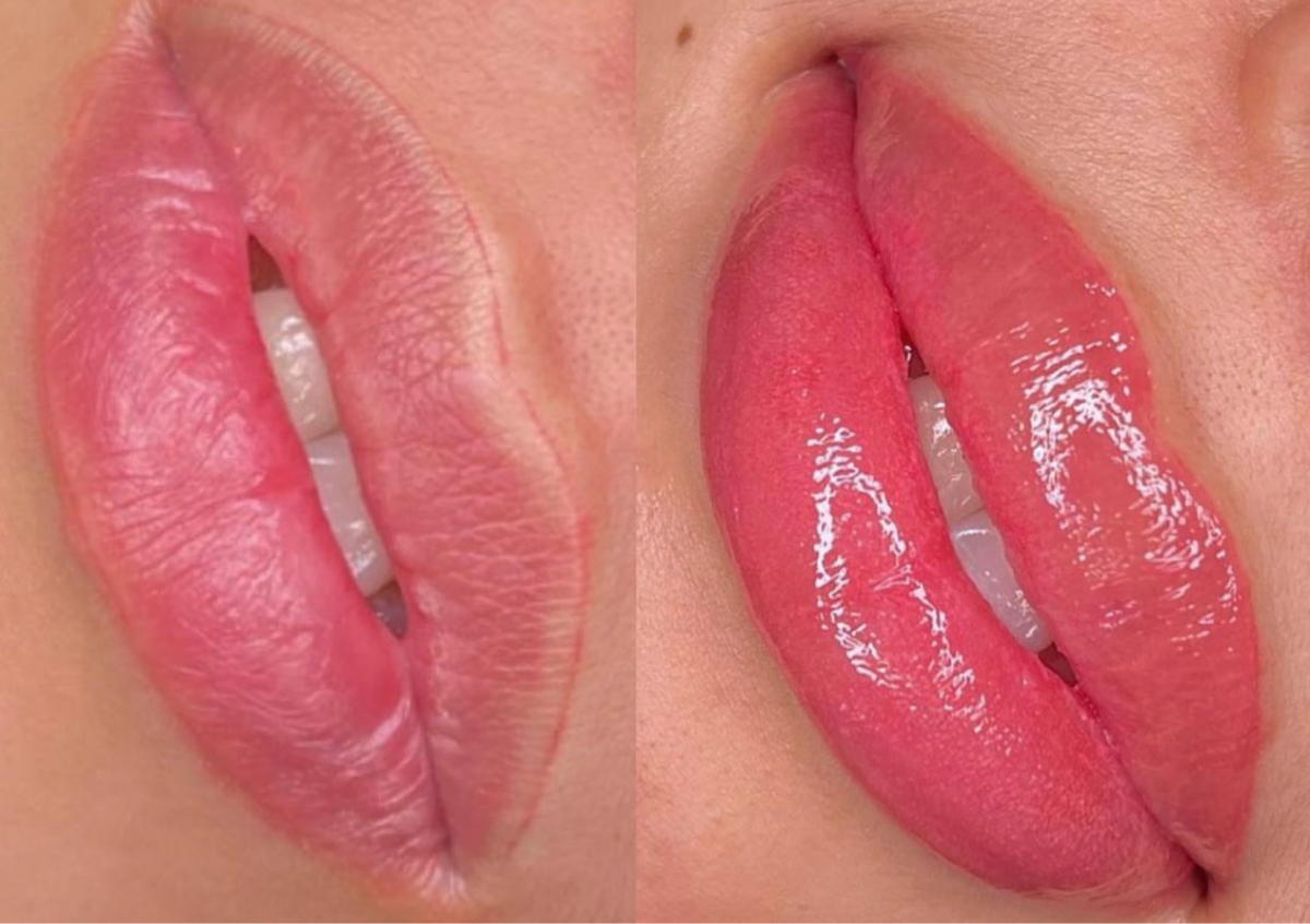 Lip Retouch after 4 - 6 weeks