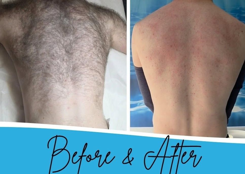 Laser Back and Shoulders