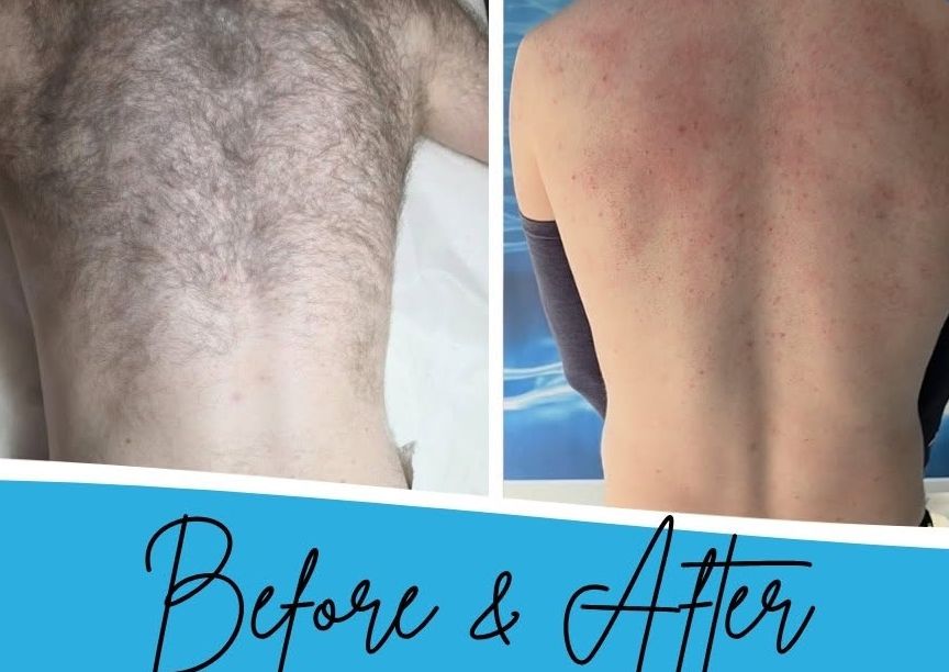 Gift voucher - Laser Back or Chest