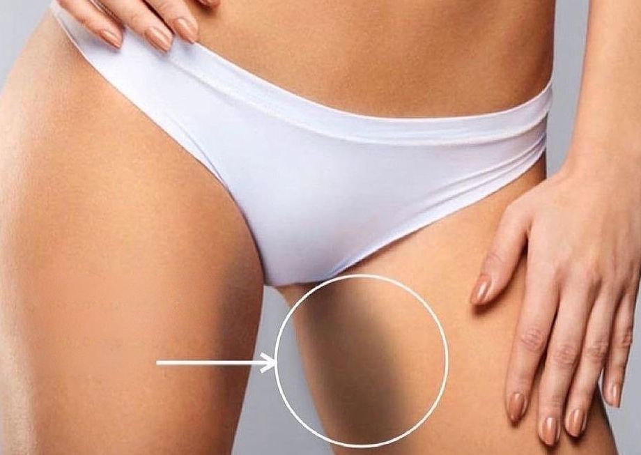 Blanquemiento intimo