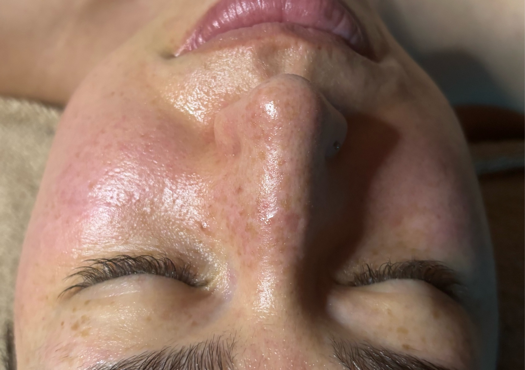 Dermaplane PLUS chemical peel