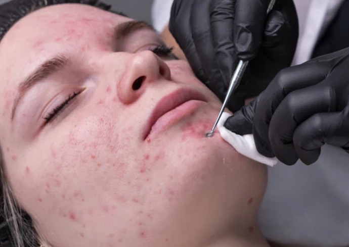 Acne Facial✨🧖🏽‍♀️