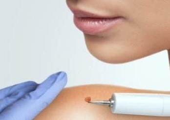 Eliminacion de verrugas 