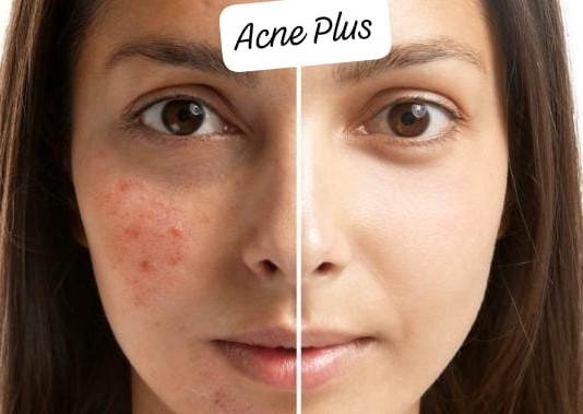 Antiacne Plus