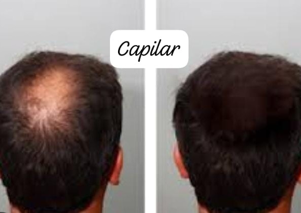 Tratamiento Capilar