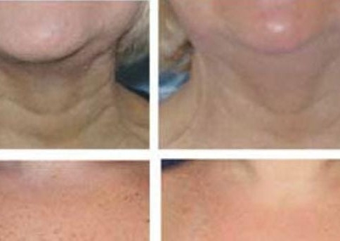 Rejuvenecimiento de Cuello y escote microneedling 