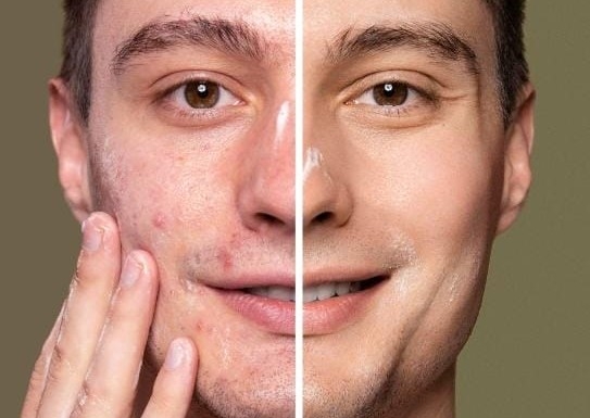 Tratamiento Antiacne 