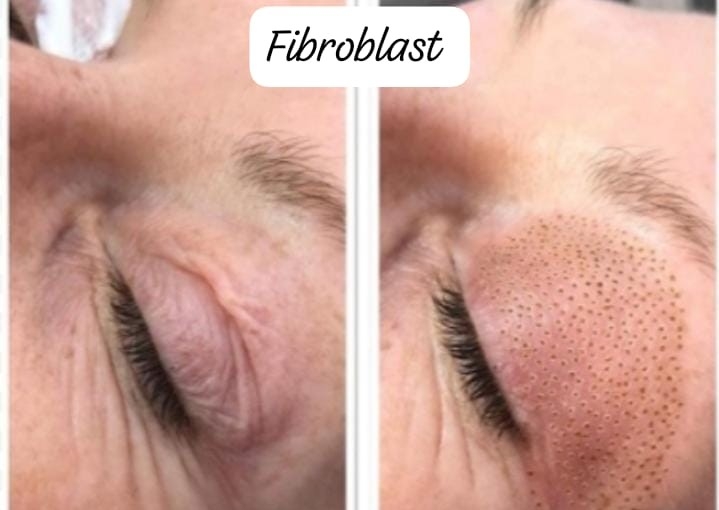 Fibroblast