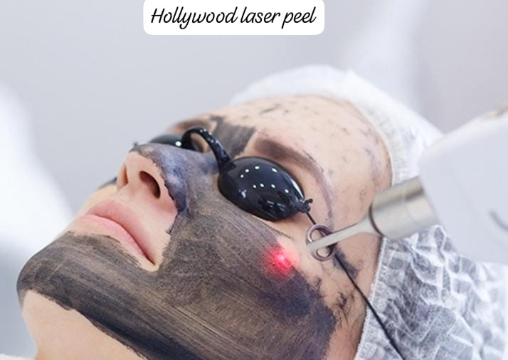 Hollywood Peel ( Carbon laser) incluye limpieza