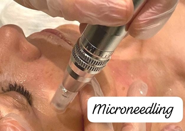 Microneedling rejuvenecimiento incluye limpieza