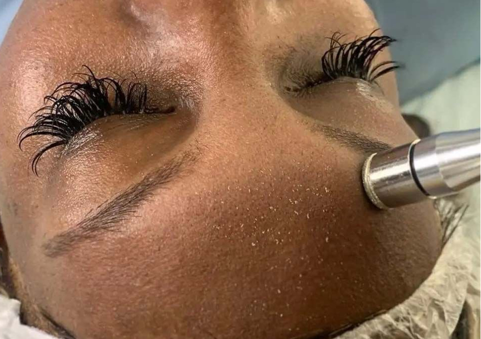 Microdermabrasion (Ultimate Facial)  