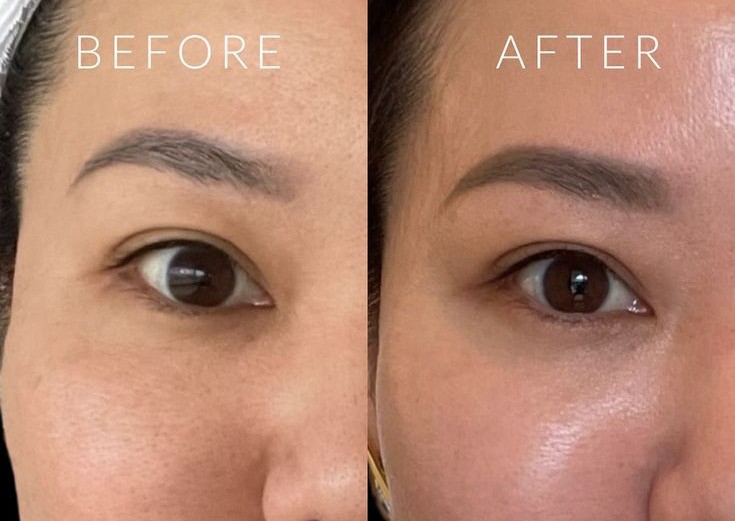 Hydra Facial 10 in 1