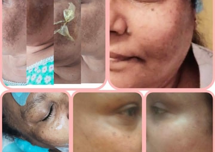 Microneedling For Pigmentation