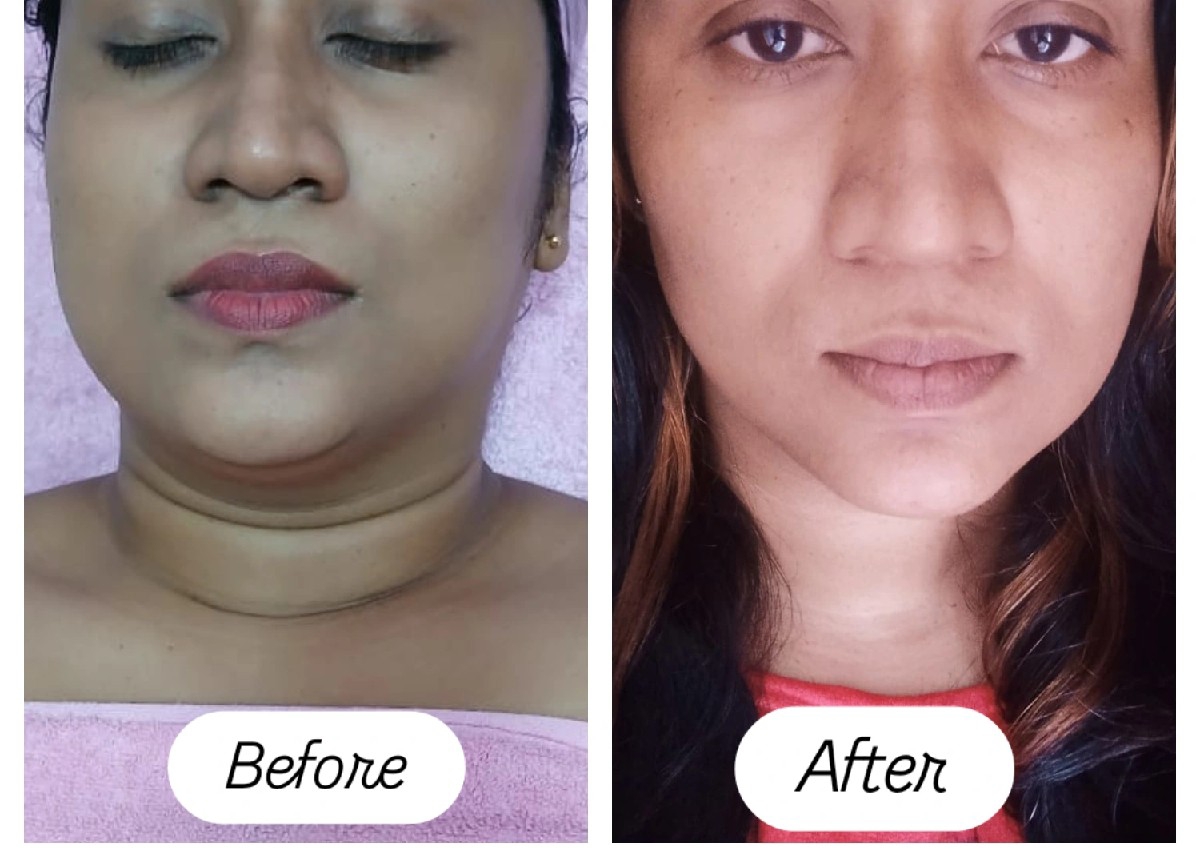 Double Chin Reduction Ultrasound 
