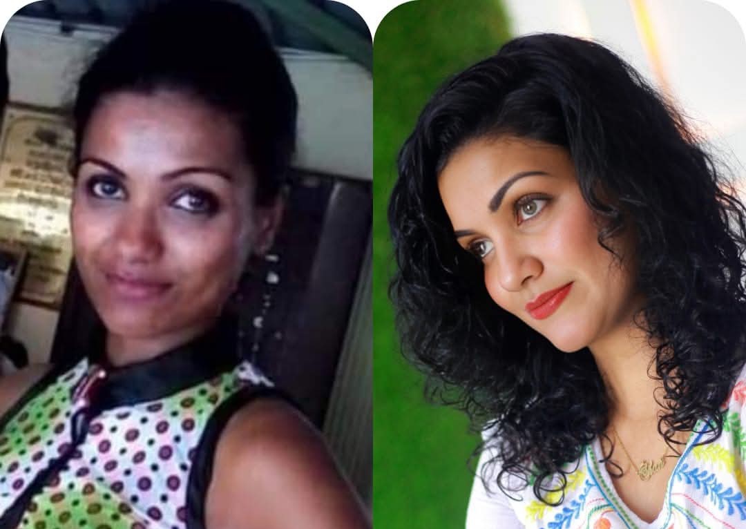 Skin Whitening Injection