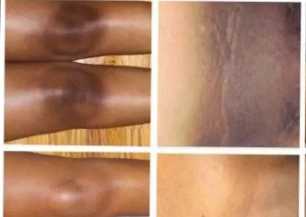 Kojic Powder Therapy