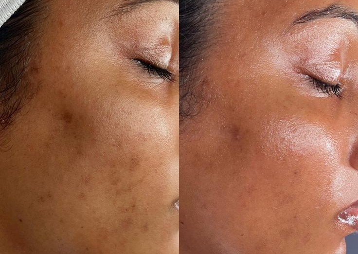 Hydra Facial 11 in 1