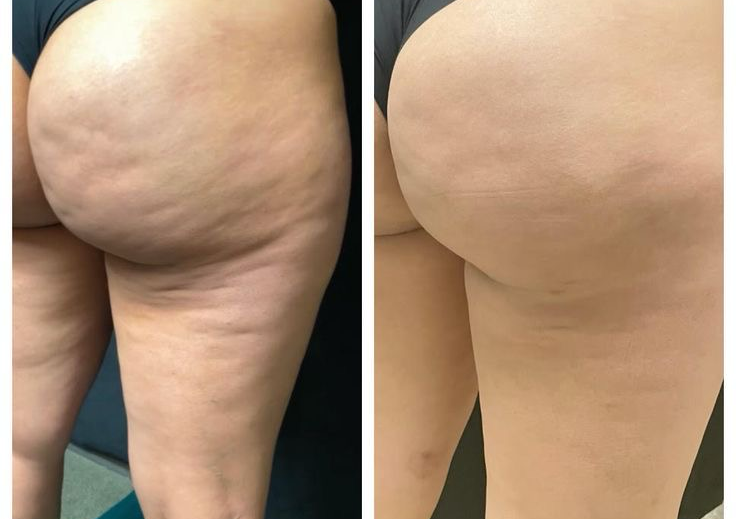 Perfect Body Contour Package