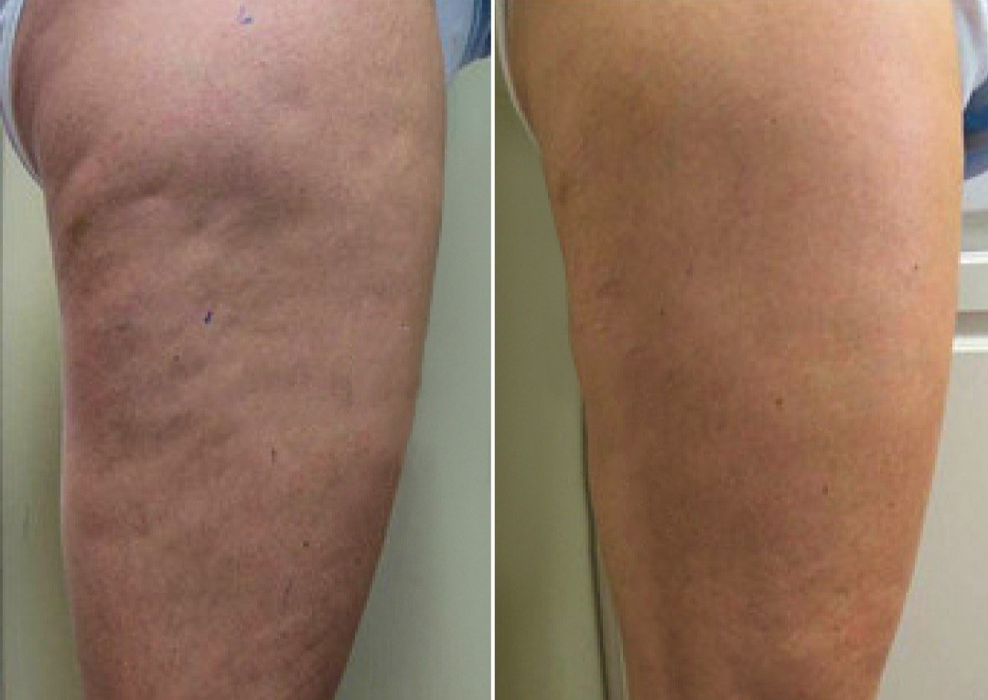 Leg Sculpt – Cellulite & Lymphatic Drain