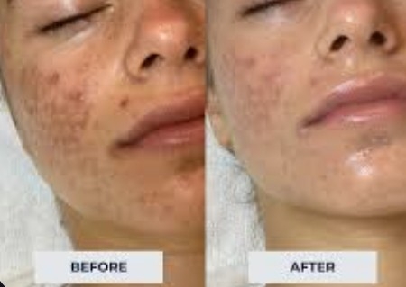 Microdermabrasion on teens 