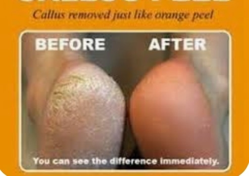 Add callus peel