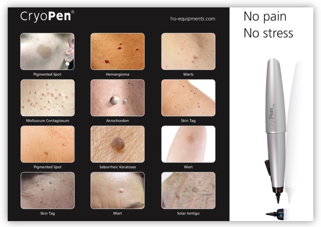 Cryopen Therapy Consultation