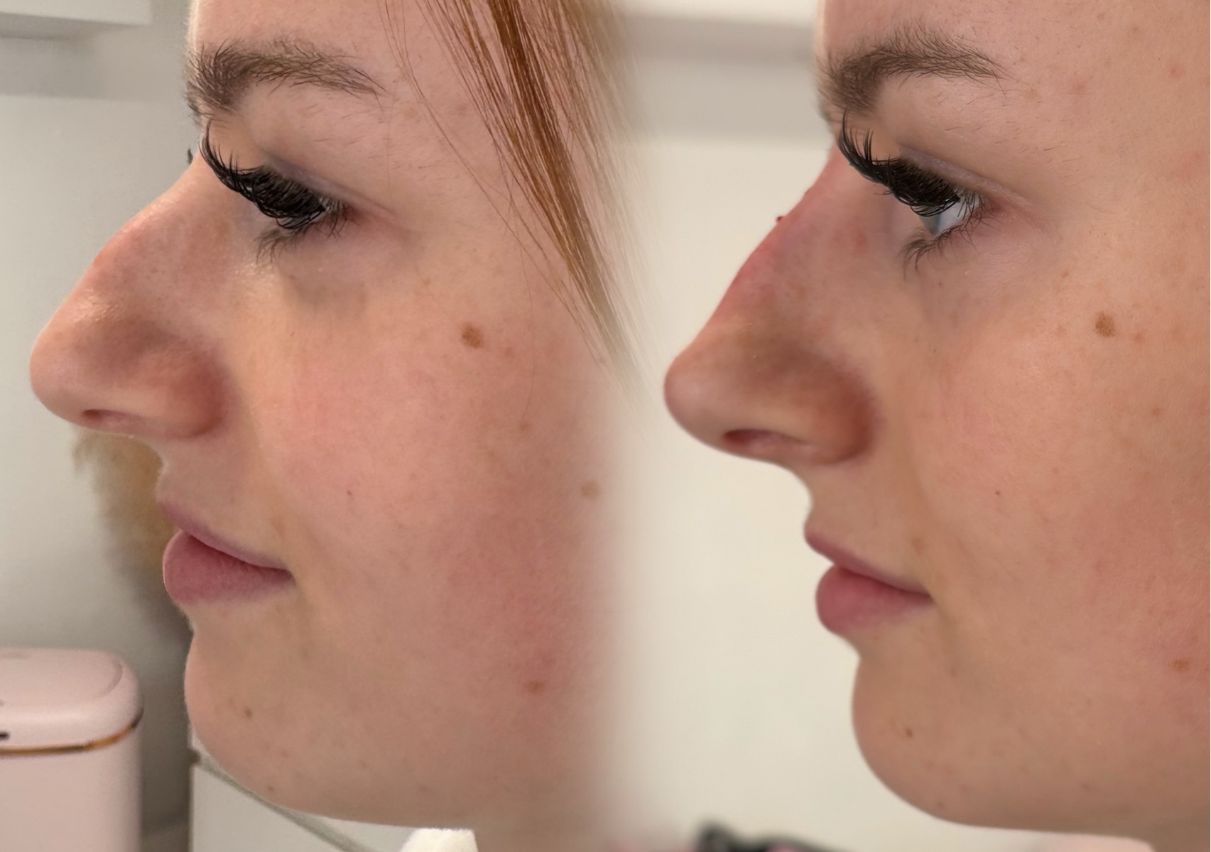 Non surgical Rhinoplasty