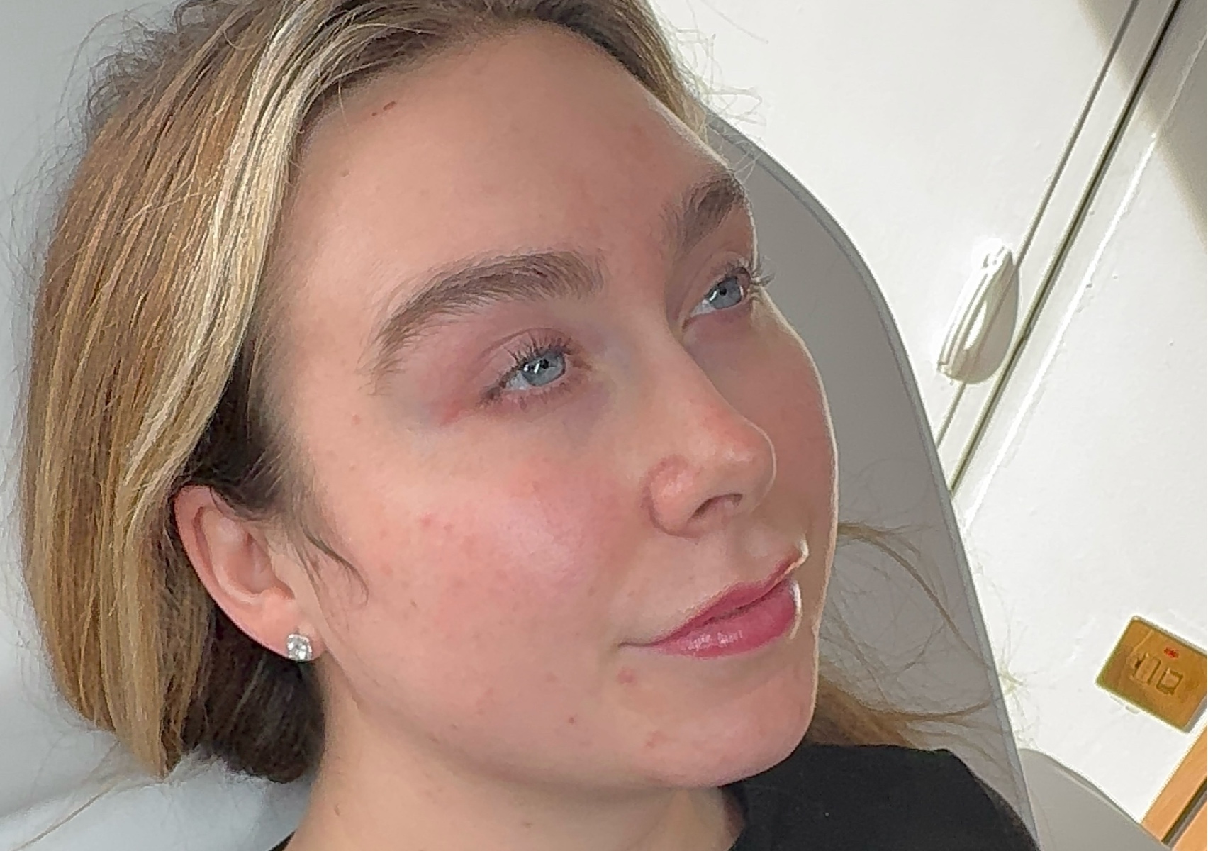 Skin Boosters (face)