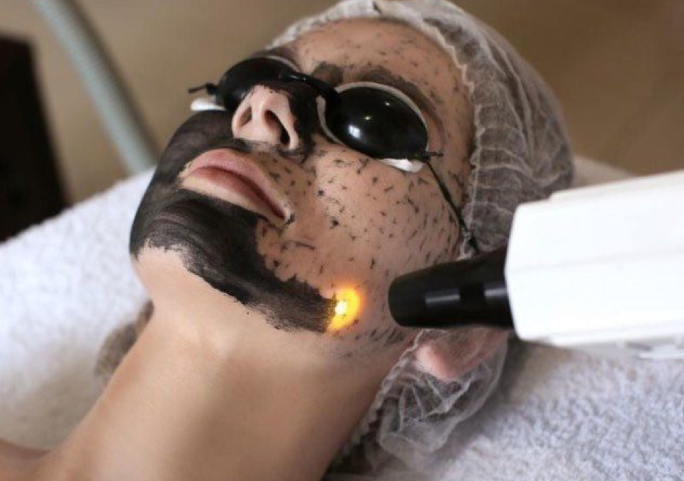Facial (carbon peel)