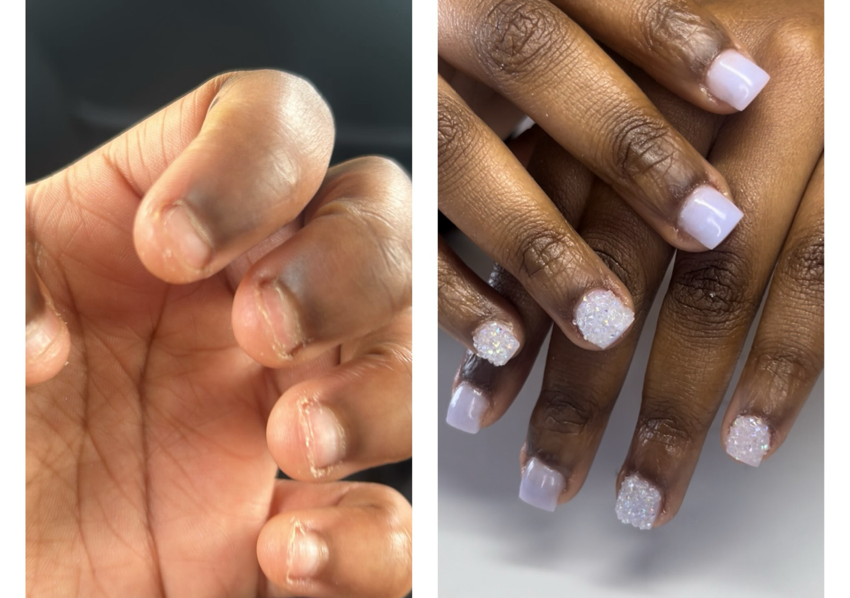 Extremley bitten nails  Acrylic Full set