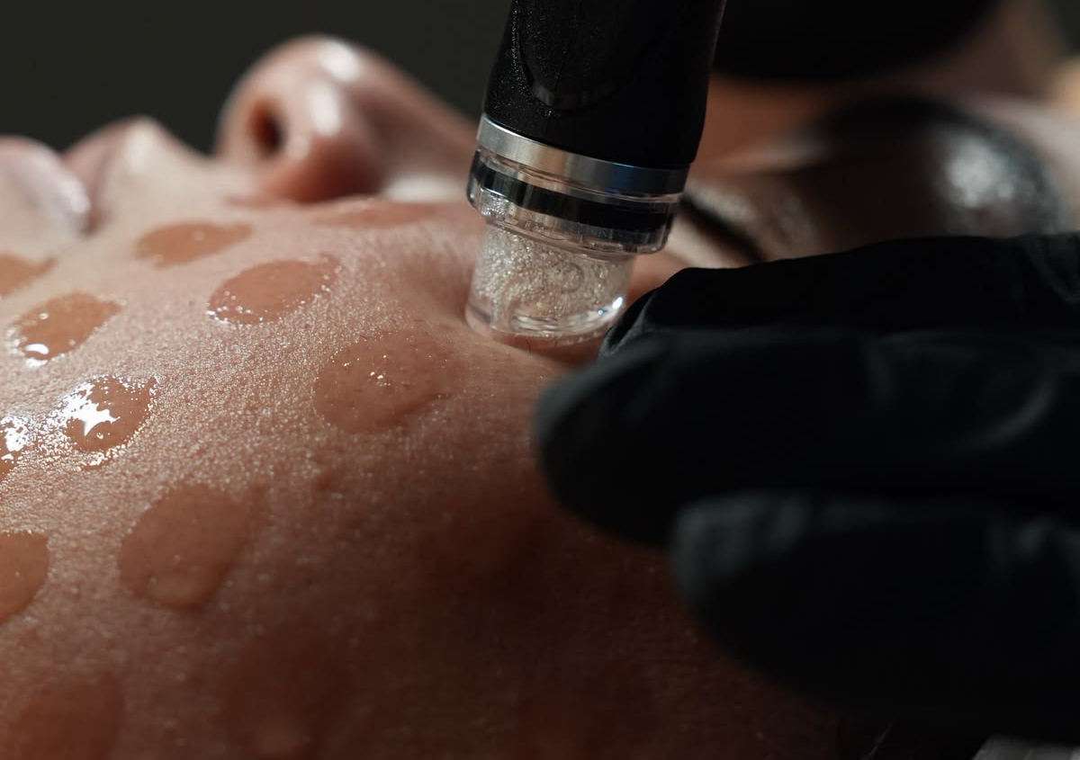 Hydrofacial 