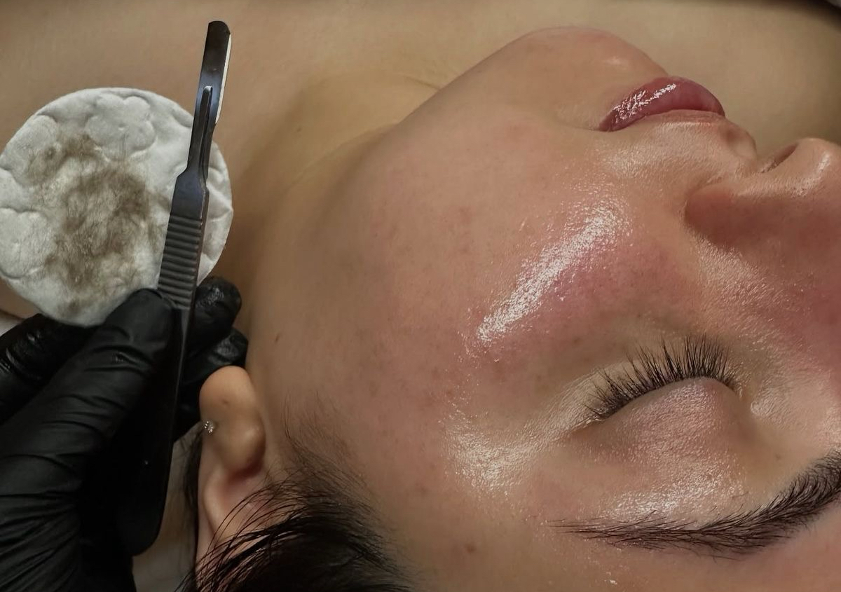 Dermaplaning 