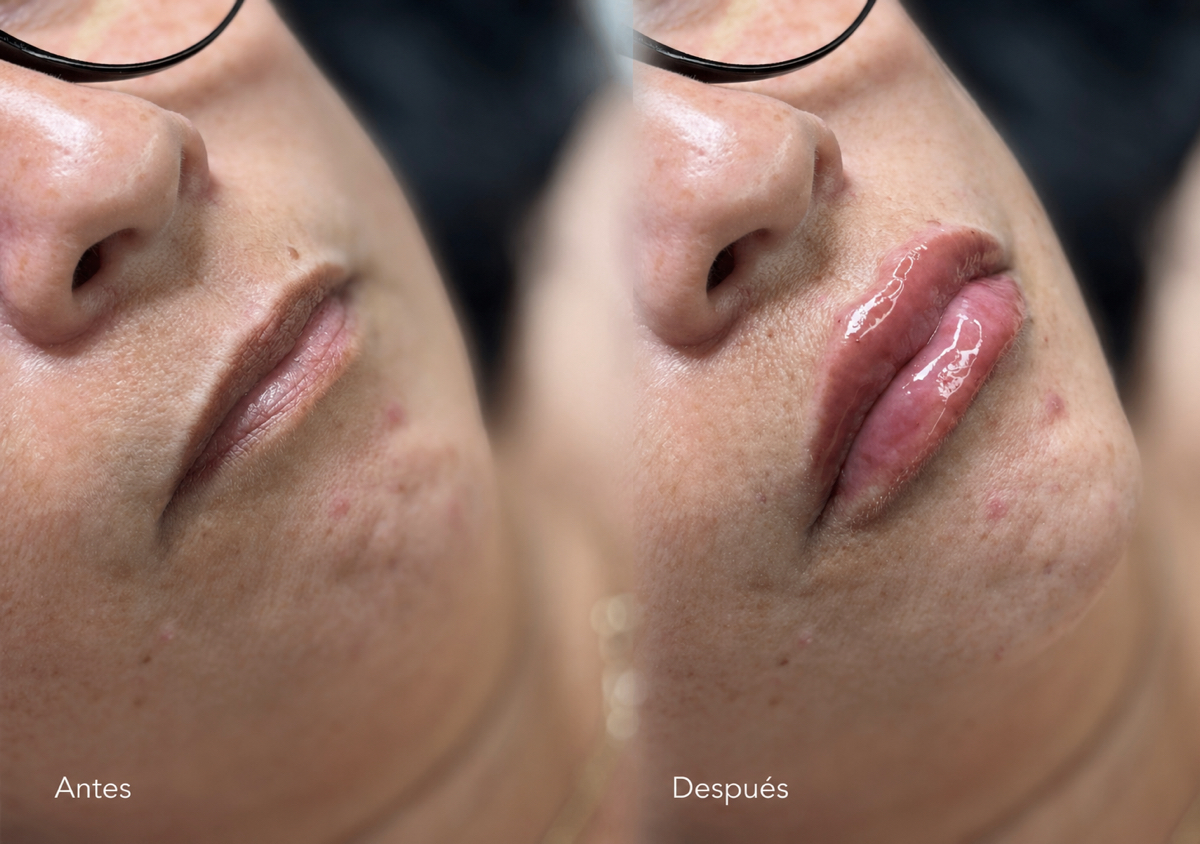 Aumento 1.0 ML