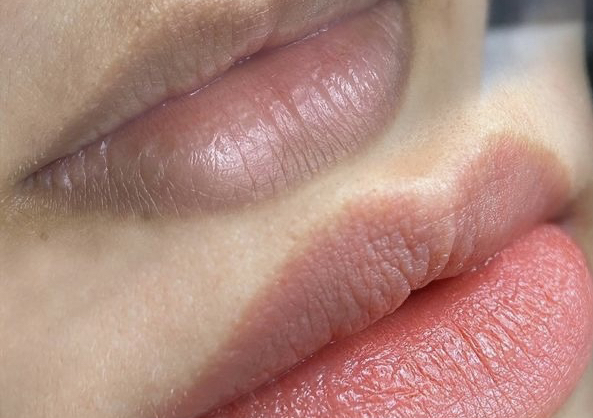 Lip Neutralization (Dark Lips Correction)