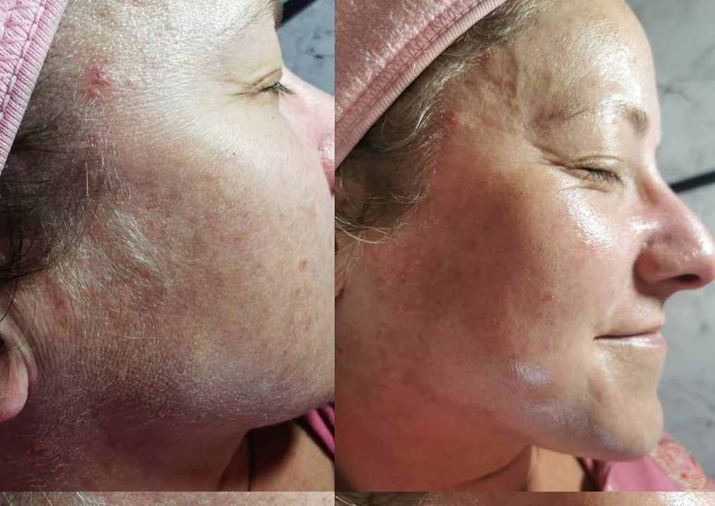 Dermaplaning facial