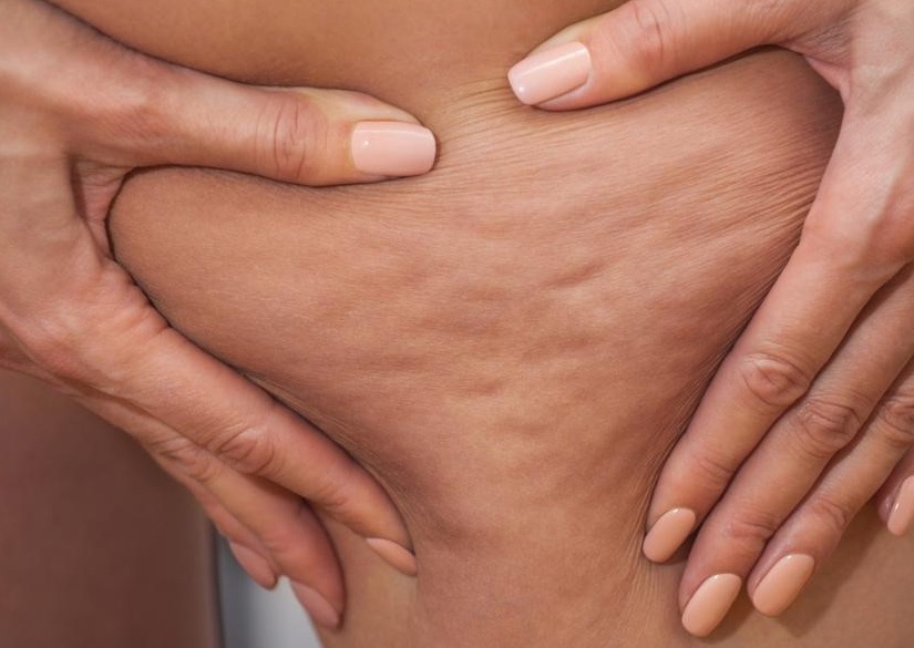 Cellulite Treatment 4 sessions