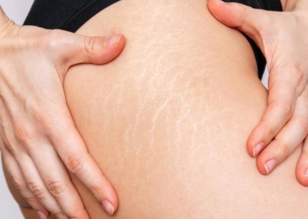 Stretch Marks Treatment 4 sessions